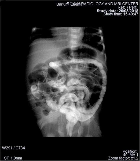 meconium plug syndrome | Bottle, Voss bottle, Water bottle