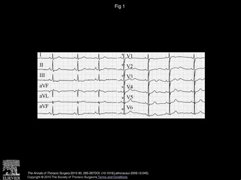 Cardiac Surgery For A Patient With Andersen Tawil Syndrome Ppt Download