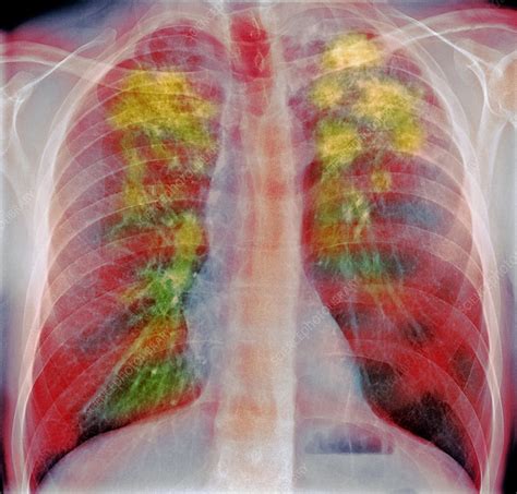 Sarcoidosis | Respiratory Conditions | OneWelbeck Lung Health