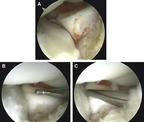 Minimal Invasive Management Of Scaphoid Fractures From Fresh To