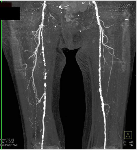 Severe Peripheral Vascular Disease Pvd With Dual Energy And Single