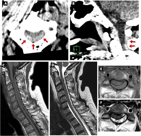 Figure From Spontaneous Cervical Epidural Hematoma Presenting With