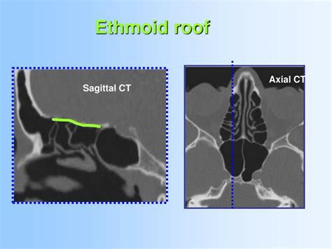 Ppt Anatomy And Relevant Anatomical Variants In Nasal And Paranasal