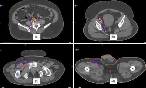 Showing Target Volume Delineation Of A Pelvic Node B Obturator Node Download Scientific