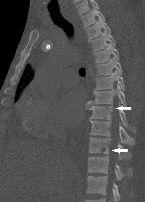 CT of the chest with contrast showing the bone lytic lesions in the ...