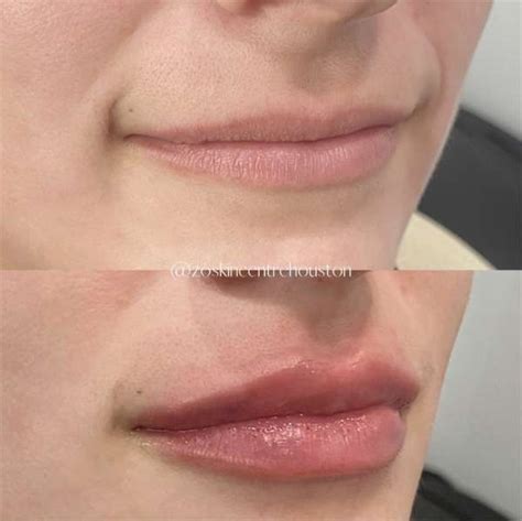 Lip Flip Vs Filler Zo Skin Centre Houston