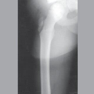 Anterior Posterior Radiograph Of The Right Hip Showing A Fracture Or