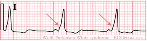 Ekg Quiz Misc Flashcards Quizlet