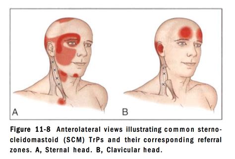 Sternocleidomastoid Stretch These Are The Stretches That Neck Pain