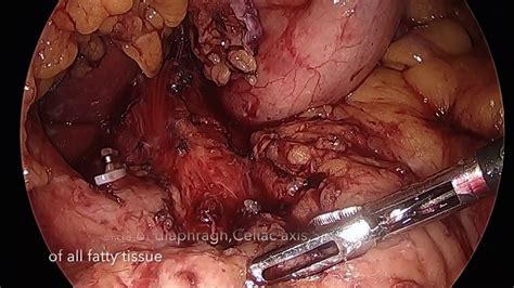 Laparoscopic BURSECTOMY In Gastric GE Junction And Oesophageal