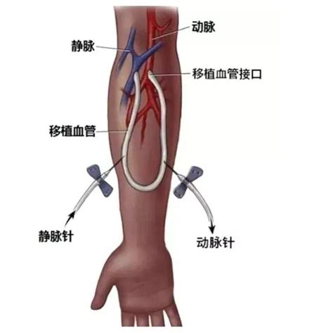 关注 市中心医院以“管”造“桥” 成功搭建血液透析患者的生命线血管通路治疗