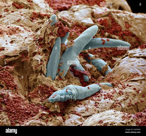 Eyelash Mites In Skin Coloured Scanning Electron Micrograph Sem