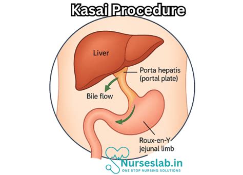 Kasai Procedure: A Lifeline for Infants with Biliary Atresia - Nurseslab