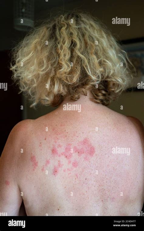 Varicella Zoster Back Shingles Hi Res Stock Photography And Images Alamy