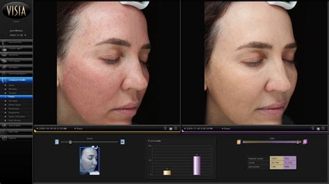 DermaPen Microneedling Collagen Induction Therapy Non Invasive