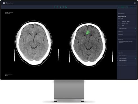 Eirlエイル Ai画像診断支援技術 エルピクセル株式会社 Eirl（エイル）は、ct Mri 病理画像などの医療画像を