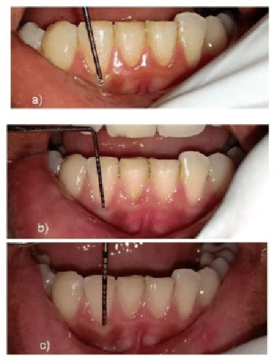 Pdf Effect Of Injectable Platelet Rich Fibrin I Prf On Thin