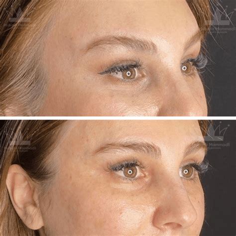 Endoscopic Brow Lift And Forehead Lift Surgery