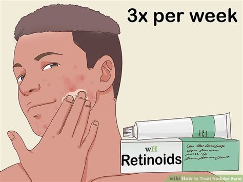 How to Treat Nodular Acne: 12 Steps (with Pictures) - wikiHow