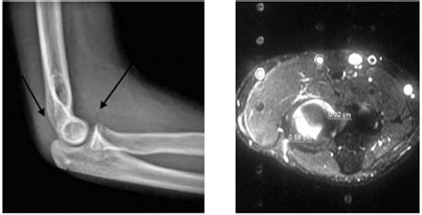 11 Years Old Male Patient With History Of Trauma And Elbow Pain With