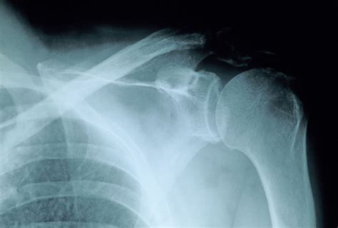 Proximal humerus fracture - tatkanic