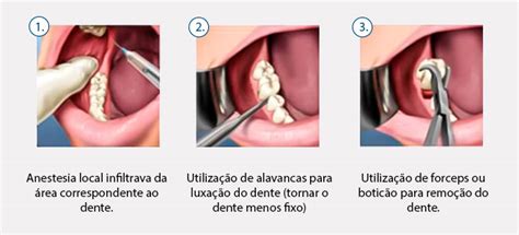 Como Arrancar Dente De Leite De Crian A Em Rela O Crian As