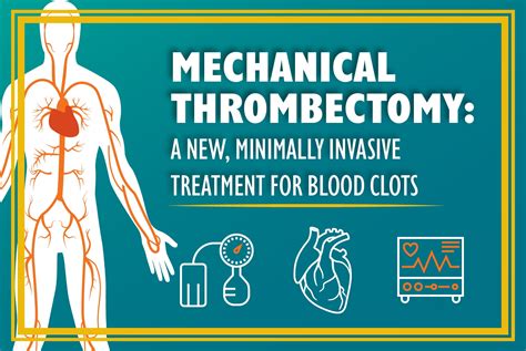 Mechanical Thrombectomy: A Minimally Invasive Treatment for Blood Clots ...