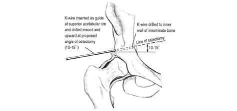 A Kirshner Wire Or Steinmann Pin Is Inserted As A Guide At The Middle