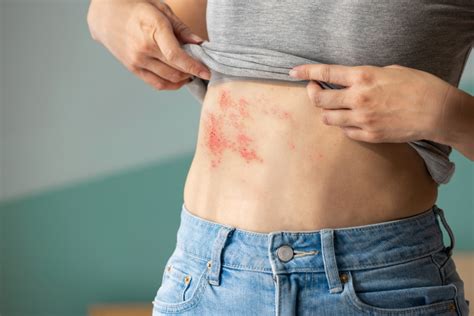 Why Are Painful Blisters From Shingles Appearing On People Under