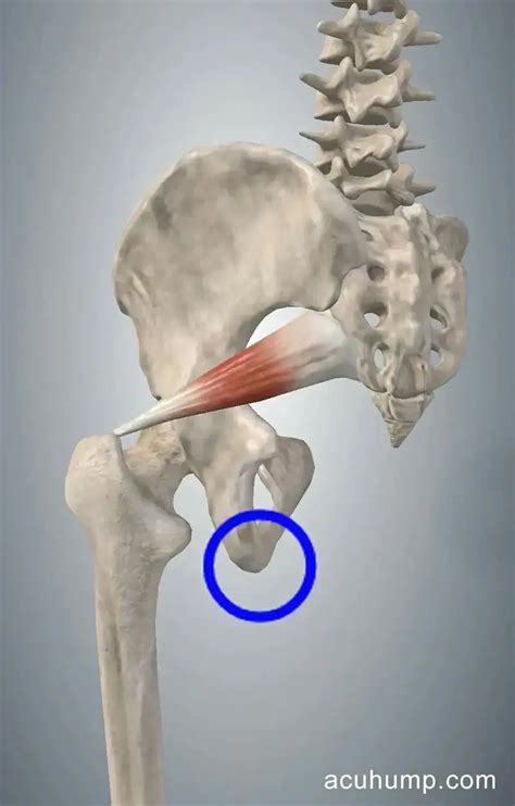 Ischial Bursitis Vs Piriformis Syndrome Acu Hump Blog