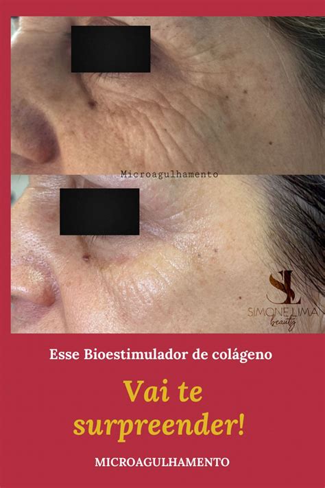 Microagulhamento Em 2023 Microagulhamento Microagulhamento Facial