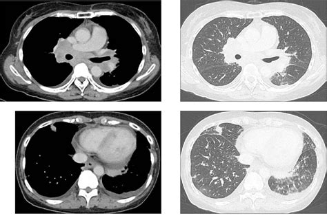 Figure 1 From A Case Of Sarcoidosis Presenting As Organizing Pneumonia