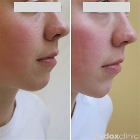 Weak Chin Treatment London Jawline Fillers Hedox Clinic