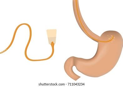 Nasogastric Tube Stock Illustration Shutterstock