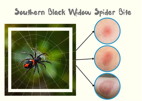 17 Types Of Spider Bite Symptoms Id With Pictures