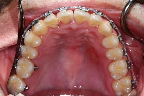 Upper Arch With Braces Createsmiles By Dr Brad Lockhart Tustin Dentist