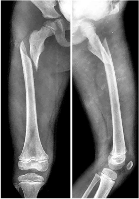 Femoral Shaft Fracture