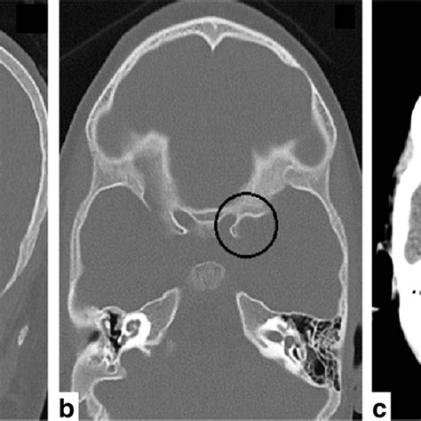 Coronal A And Axial B Noncontrast Head Ct With Bone Windows From