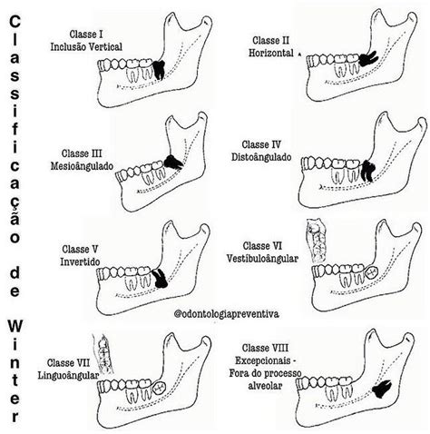 Winter S Classification The Classification Is Based On The Inclination