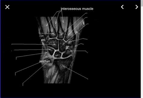 Wrist bones anatomy Diagram | Quizlet