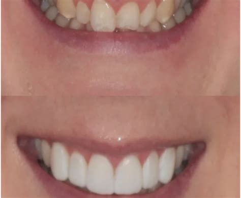 Can Composite Bonding Fix Crooked Teeth