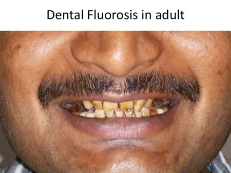 Skeletal Fluorosis - a case report