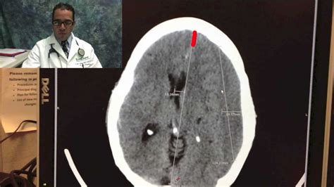 Epidural Vs Subdural Hematoma Ct Scan