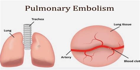 Pulmonary Embolism - Assignment Point