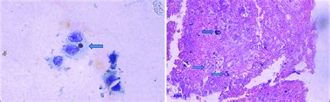 A Cerebrospinal Fluid Cytology From Cytocentrifuge Deposit Showing Download Scientific