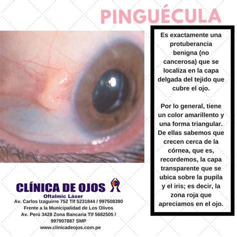 Que Es Una Pinguecula En El Ojo Consejos Ojos