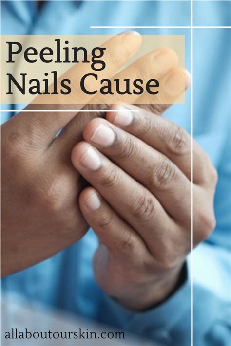 Peeling Nails Cause Peeling Nails Flaking Nails Brittle Nails Treatment