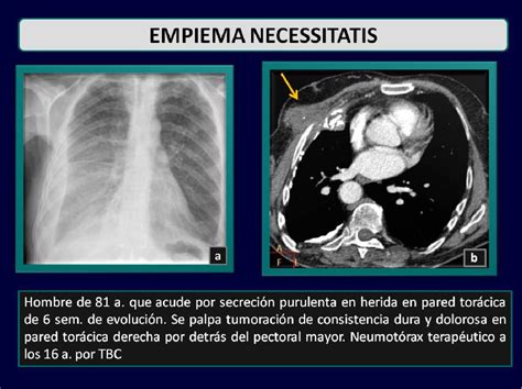 Figure From Manifestaciones Radiol Gicas De La Tuberculosis Pulmonar