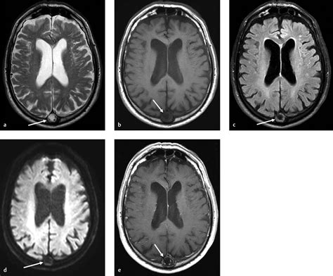 2 Arachnoid Granulations Radiology Key