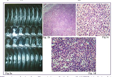 T Cell Histiocyte Rich Large B Cell Lymphoma Of Posterior Mediastinum Semantic Scholar